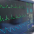 Kenali EKG Jantung: Manfaat, Proses Pemeriksaan, dan Interpretasi Hasil