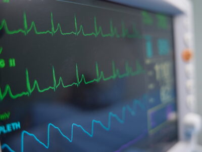 Kenali EKG Jantung: Manfaat, Proses Pemeriksaan, dan Interpretasi Hasil