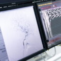 Mengenali Prosedur Coronary Angiography (CAG)