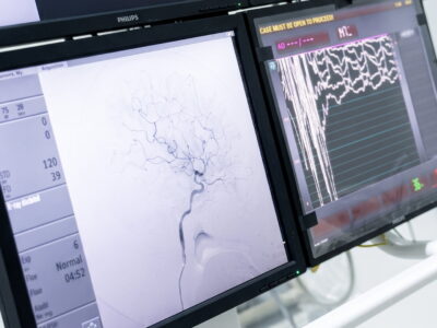 Mengenali Prosedur Coronary Angiography (CAG)