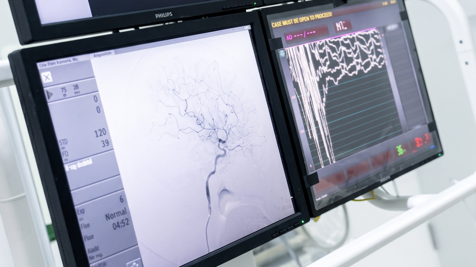 Mengenali Prosedur Coronary Angiography (CAG)