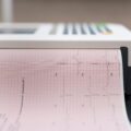 Panduan Lengkap EKG (Rekam Jantung): Prosedur, Fungsi, dan Kapan Harus Melakukannya